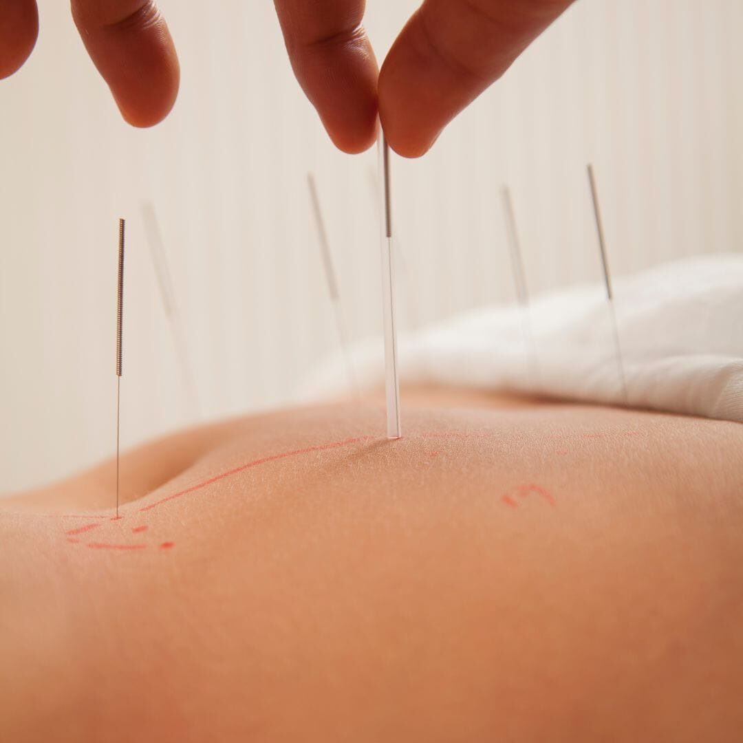 Pregnancy acupuncture